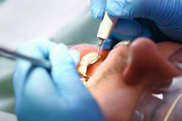 Best Emergency Tooth Extraction in Mission Viejo, CA
